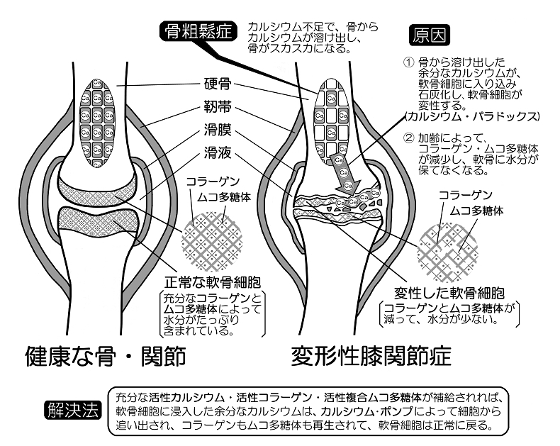 変形性膝関節症