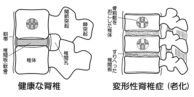 変形性脊椎症について